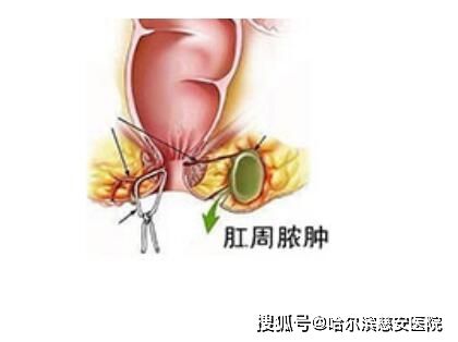 传输端点尚未连接（肛周脓肿高位脓肿怎么发现）-图2